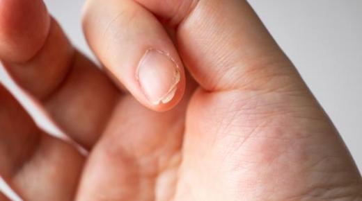 علامات تدل على نقص الفيتامينات في جسم الإنسان