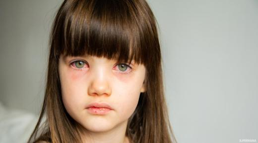 “احمرار العيون عند الأطفال” .. تعرف على أهم الأسباب