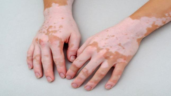 بعد انتشاره.. أسباب الإصابة بمرض البهاق