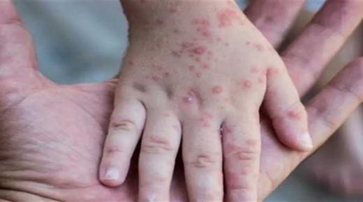 بريطانيا:نرصد إصابات يومية بجدري القرود