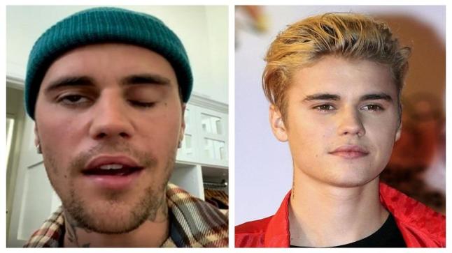 كل ما تريد معرفته عن متلازمة رامزي هانت