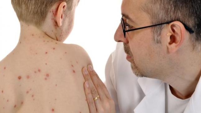 الصحة العالمية تحذر من انتشار مرض الحصبة بين الأطفال وتؤكد الظروف مثالية
