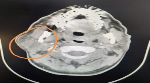 مجمع فيصل الطبي بالطائف يعلن عن نجاحه في استئصال ورم في المخ لمريض خمسيني
