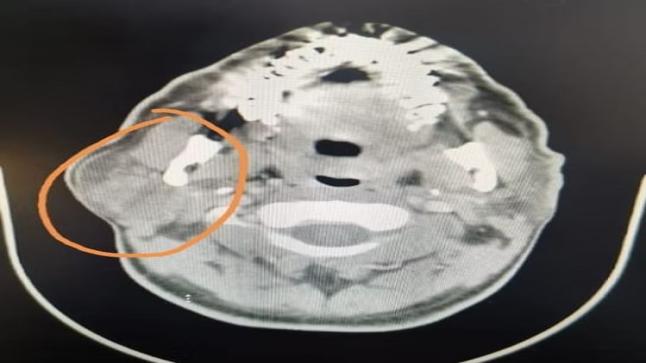 مجمع فيصل الطبي بالطائف يعلن عن نجاحه في استئصال ورم في المخ لمريض خمسيني